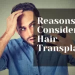 Reasons to Consider a Hair Transplant